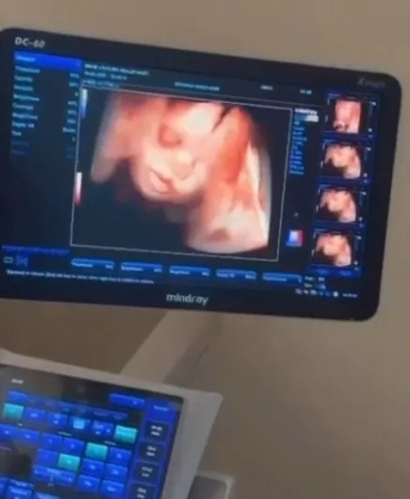 Sinop Hastanesi’nde 4D Ultrason Dönemi Başladı!