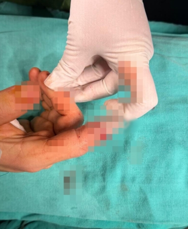 Bandırma’da Asansör Kazasında Kopan Parmak Kurtarıldı